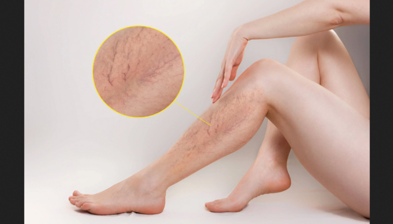 El mejor tratamiento para las varices en las piernas